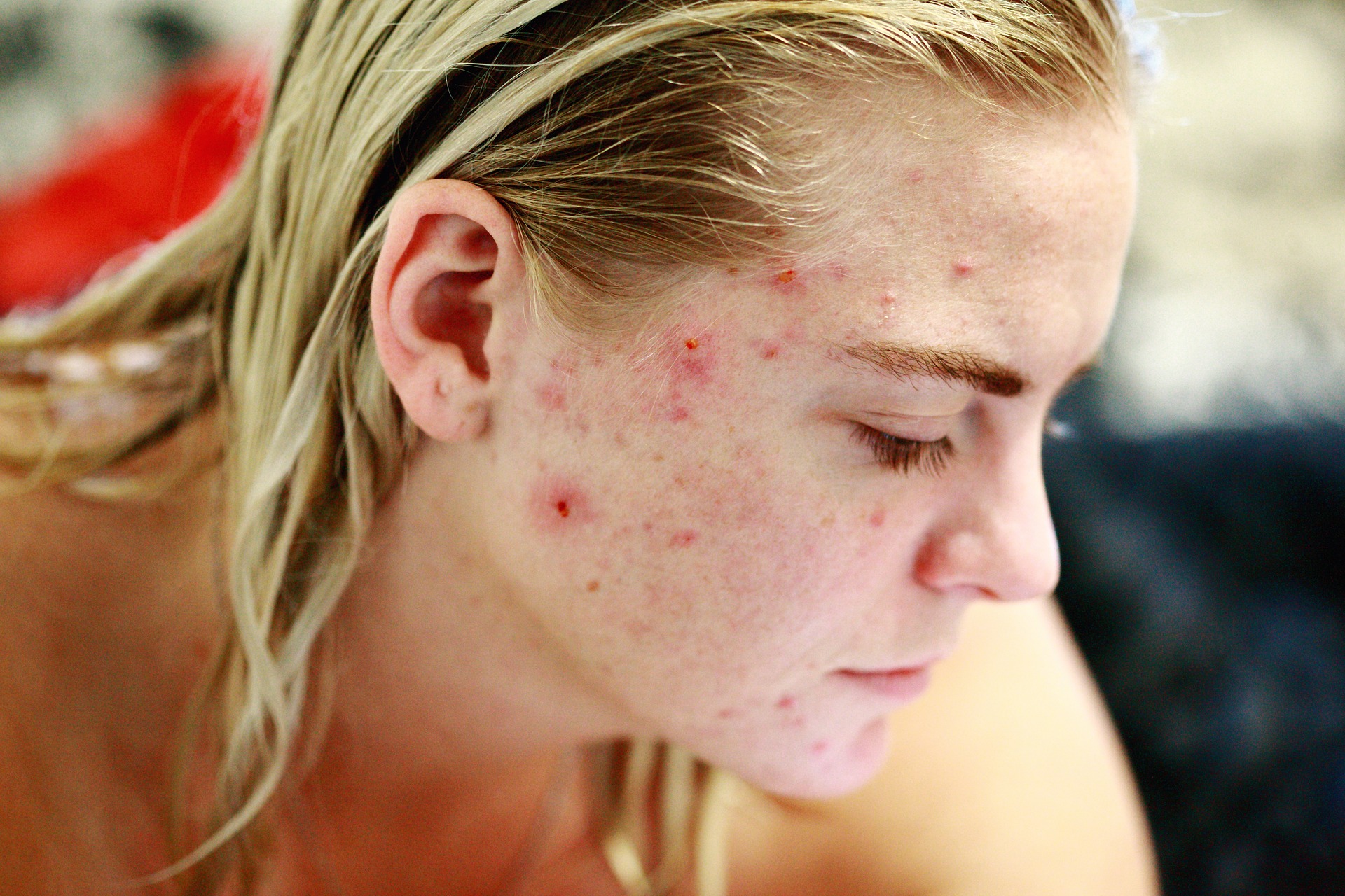 Suffering from Acne? Here are 15 Tips to Improve Your Skin Condition
